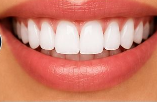 Smile after whitening